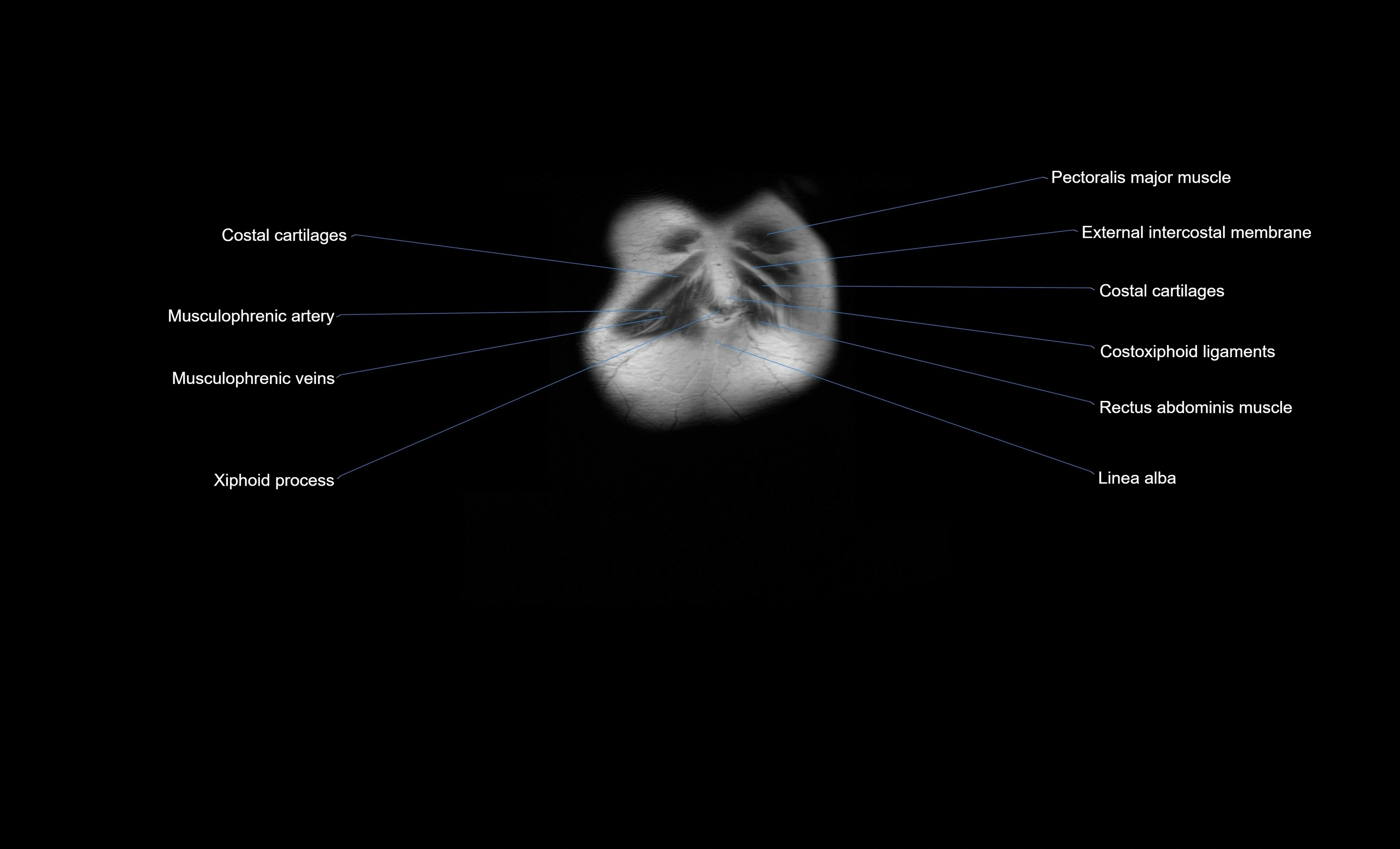 MRI Abdomen coronal labelled cross sectional anatomy radiology  image-img-00001-00003.webp
